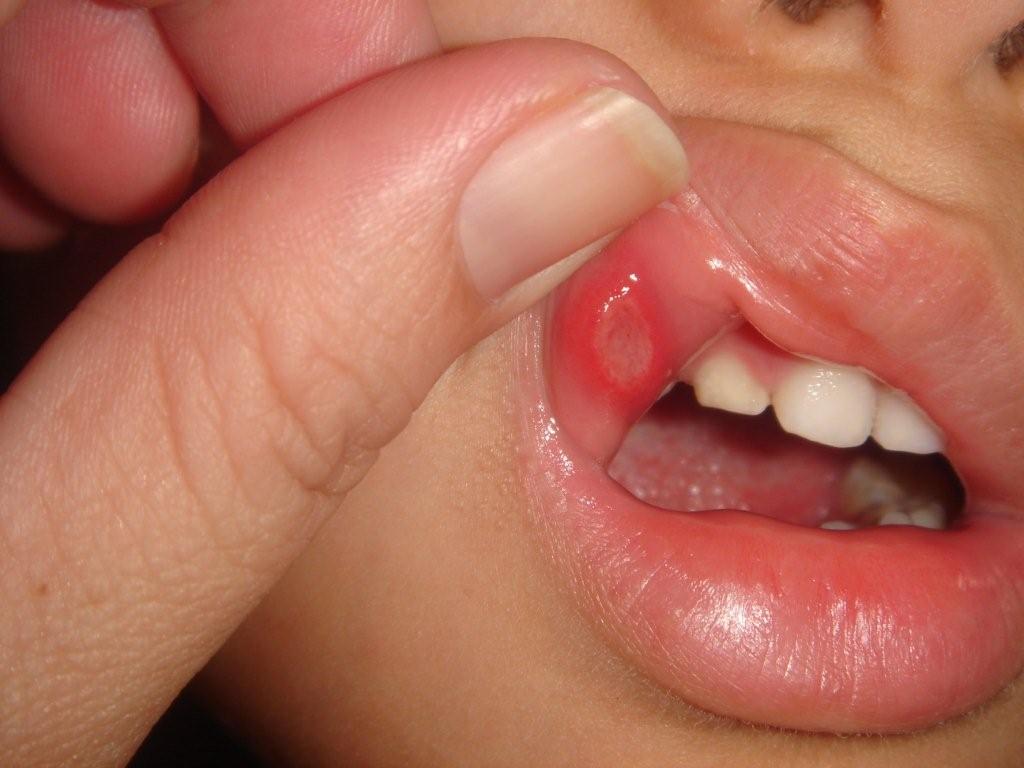 علاج فطريات الفم عند الأطفال الرضع..!