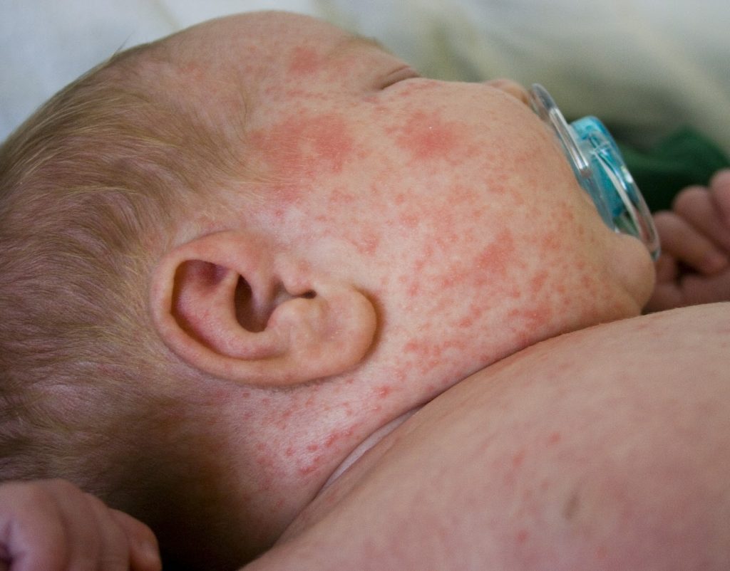 القضاء على حساسيه الجلد عند الأطفال